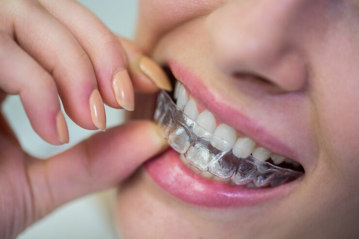 Best Invisible Braces Service in Faridabad