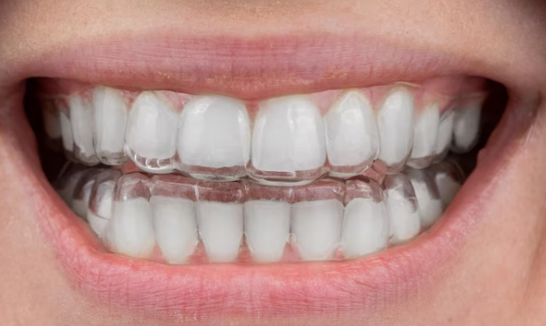 Best Teeth Clear Aligners in Faridabad