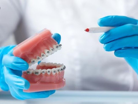 Best Dental Braces Specialist in Faridabad